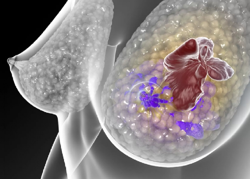 Posicionamento da SBOC sobre câncer de mama metastático triplo-negativo: finalmente um avanço importante no tratamento