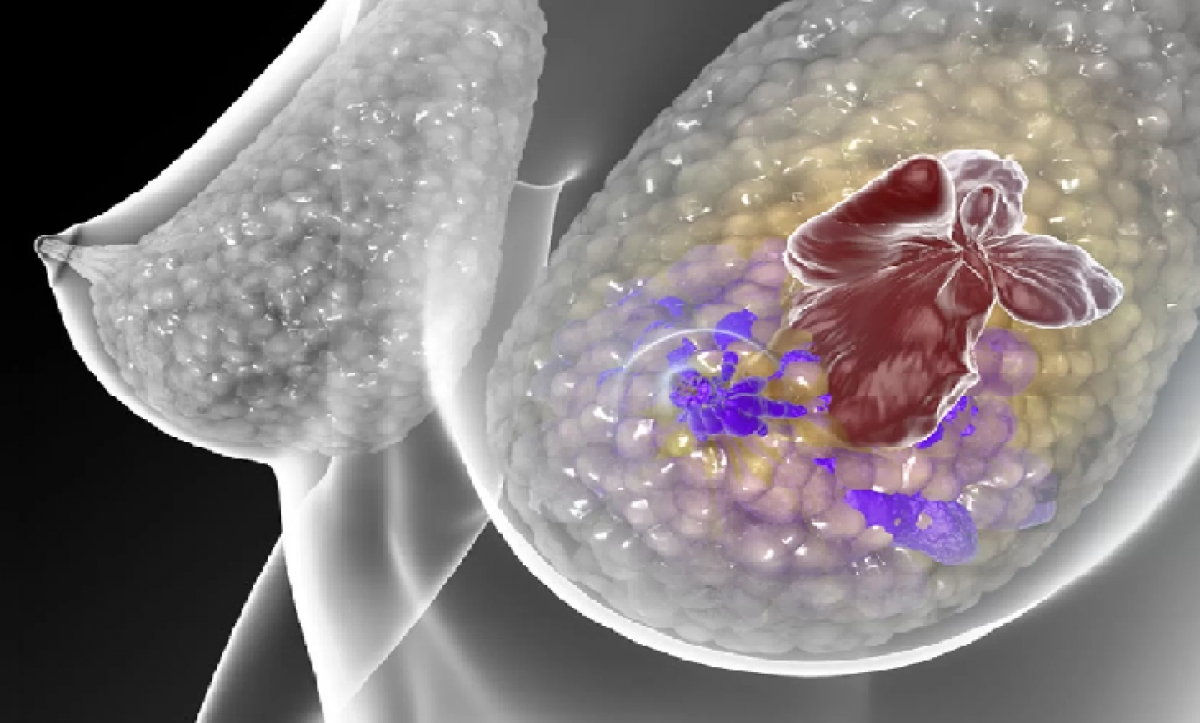 Posicionamento da SBOC sobre câncer de mama metastático triplo-negativo: finalmente um avanço importante no tratamento