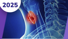 Carcinoma de tireoide: medular