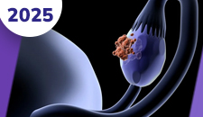 Ovário: tumores epiteliais