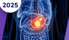 Sarcomas gástricos (GIST)